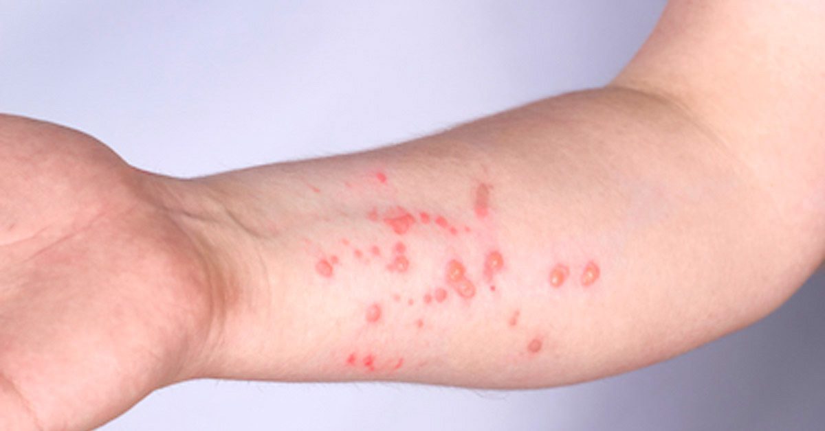 Monkeypox Karachi airport