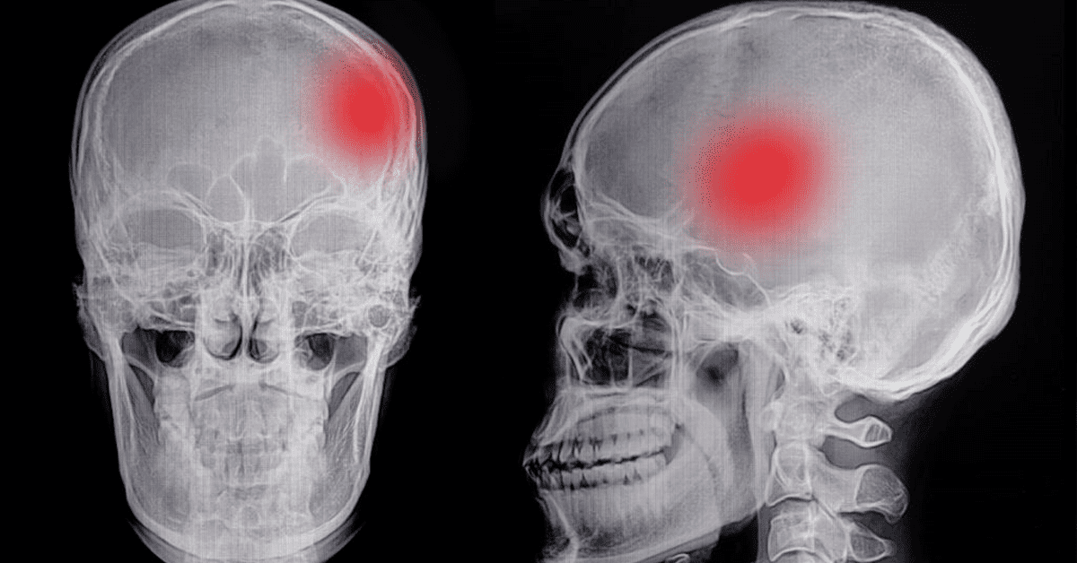 Karachi qari arrested child skull fracture 2025