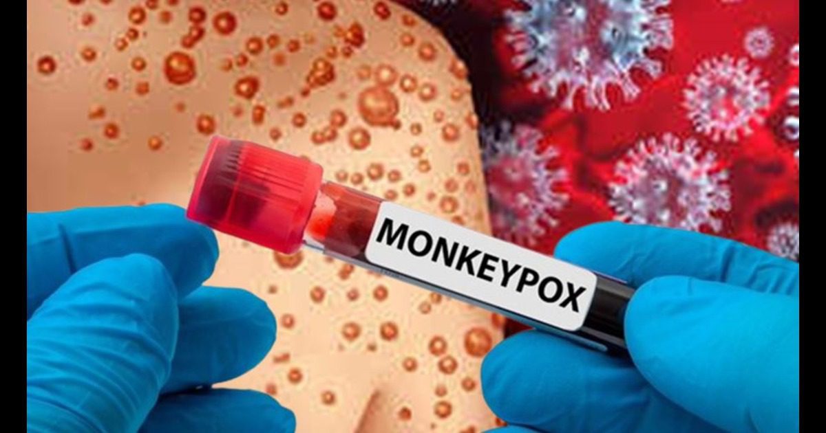 Monkeypox